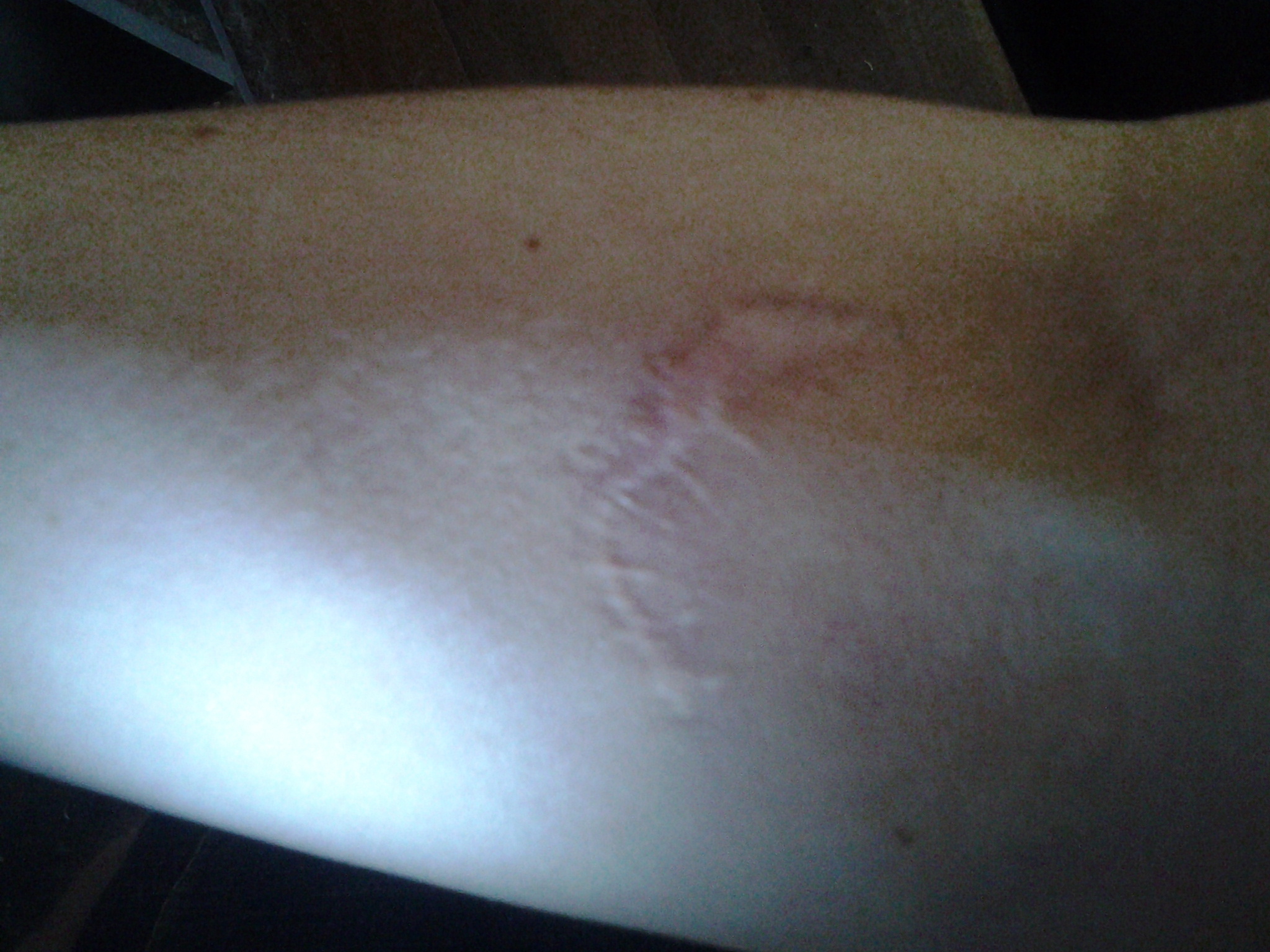 I have a pretty narly puncture/tear scar on my arm 136890571 added