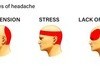 Types of headache